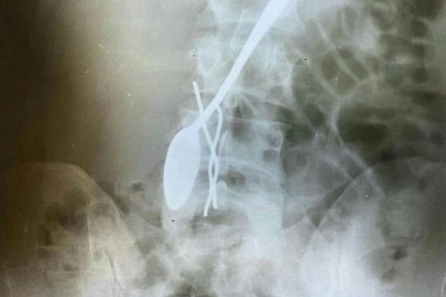 Дагестанские хирурги провели уникальную операцию молодому пациенту